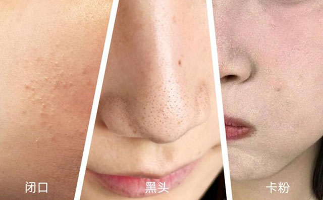 HFP果酸角质管理精华液